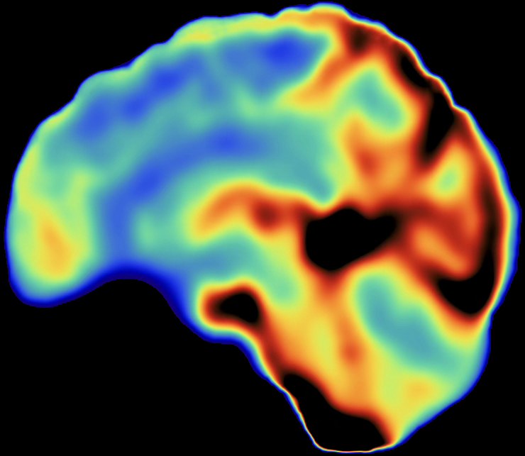 Amplitude of low-frequency fluctuation map on a sagittal brain