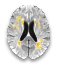 Axial FLAIR brain with white-matter hyperintensities highlighted